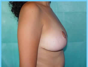 breast reduction